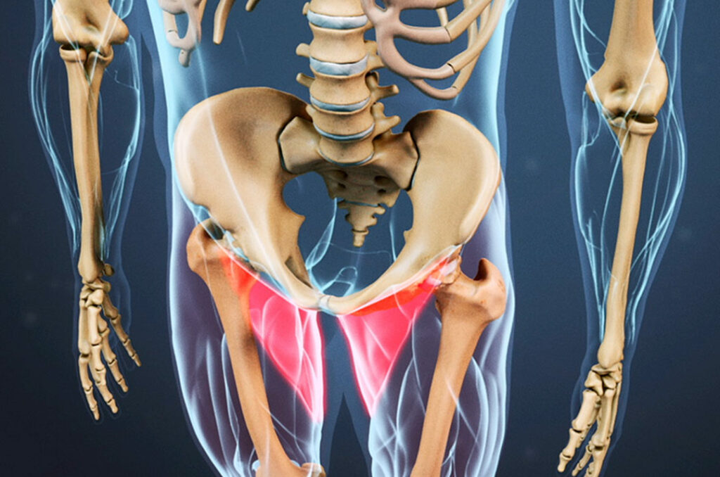 Adductor (Groin) Injuries in Soccer Players