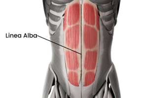 Pelvic health physical therapy treatment for diastasis Recti DRA separation at the linea alba